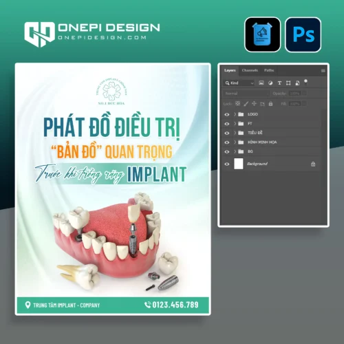 Poster nha khoa phác đồ trồng răng implant PSD N8K4P mô hình 3D